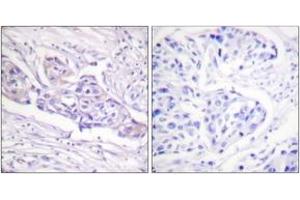 Immunohistochemistry analysis of paraffin-embedded human breast carcinoma, using FOXO1A (Phospho-Ser329) Antibody. (FOXO1 antibody  (pSer329))