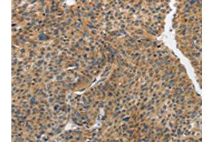 The image on the left is immunohistochemistry of paraffin-embedded Human liver cancer tissue using ABIN7191891(PIP5K1C Antibody) at dilution 1/25, on the right is treated with synthetic peptide.