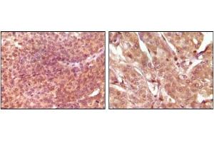 Immunohistochemical analysis of paraffin-embedded human bladder carcinoma (left) and breast carcinoma (right), showing nuclear and cytoplasmic localization using SRA antibody with DAB staining. (SRA1 antibody)
