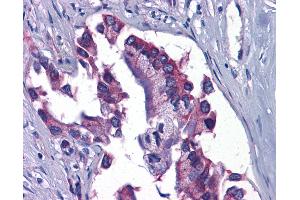 Anti-GFPT1 / GFAT antibody IHC of human Pancreas, Carcinoma. (GFPT1 antibody  (C-Term))