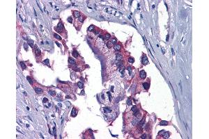 Anti-GFPT1 / GFAT antibody IHC of human Pancreas, Carcinoma.