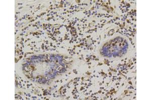Immunohistochemistry of paraffin-embedded human mammary cancer using CREB1 antibody (ABIN5996963) at dilution of 1/100 (40x lens).