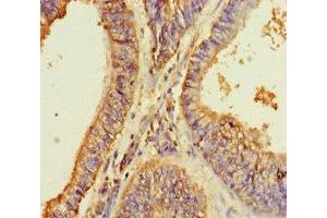 Immunohistochemistry of paraffin-embedded human endometrial cancer using ABIN7164469 at dilution of 1:100 (GPR173 antibody  (AA 210-287))