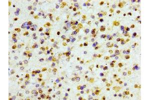 IHC image of ABIN7127295 diluted at 1:100 and staining in paraffin-embedded human glioma cancer performed on a Leica BondTM system. (Recombinant HIST1H3A antibody)