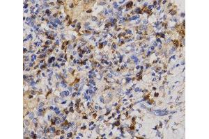 Immunohistochemistry of paraffin-embedded Human lung cancer using Eif2ak2 Polyclonal Antibody at dilution of 1:200 (40x lens). (EIF2AK2 antibody)