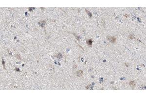 ABIN6277974 at 1/100 staining Human brain cancer tissue by IHC-P. (Presenilin 2 antibody  (Internal Region))