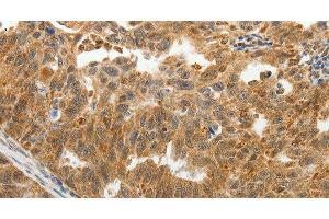 Immunohistochemistry of paraffin-embedded Human ovarian cancer tissue using SOCS7 Polyclonal Antibody at dilution 1:30