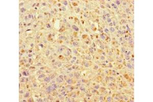 Immunohistochemistry of paraffin-embedded human melanoma using ABIN7157632 at dilution of 1:100 (KIF24 antibody  (AA 1168-1368))