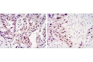 Immunohistochemical analysis of paraffin-embedded mammary cancer tissues (left) and lung cancer tissues (right) using STAT3 mouse mAb with DAB staining. (STAT3 antibody)
