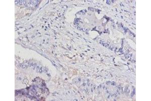 Immunohistochemistry of paraffin-embedded human colon cancer using ABIN7156799 at dilution of 1:100 (IL-15 antibody  (AA 49-162))