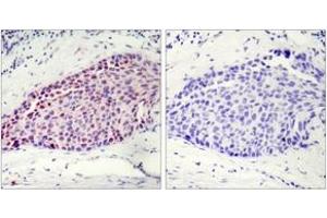Immunohistochemistry analysis of paraffin-embedded human breast carcinoma tissue, using ATF2 (Ab-112 or 94) Antibody. (ATF2 antibody  (AA 79-128))