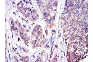 Immunohistochemical analysis of paraffin-embedded bladder cancer tissues using MAPK3 mouse mAb with DAB staining. (ERK1 antibody)