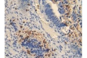 Detection of OTC in Human Colorectal cancer Tissue using Polyclonal Antibody to Ornithine Transcarbamylase (OTC) (OTC antibody  (AA 78-129))