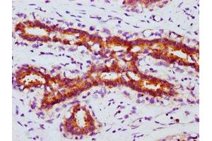 IHC image of ABIN7127694 diluted at 1:100 and staining in paraffin-embedded human breast cancer performed on a Leica BondTM system. (Recombinant FOXO3 antibody  (pSer253))