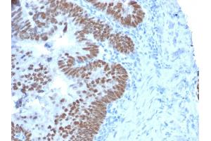 Formalin-fixed, paraffin-embedded human Colon Carcinoma stained with CDX2 Mouse Monoclonal Antibody (CDX2/2214). (CDX2 antibody)