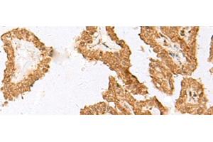 Immunohistochemistry of paraffin-embedded Human thyroid cancer tissue using FAM84A Polyclonal Antibody at dilution of 1:35(x200) (FAM84A antibody)