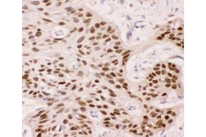 IHC-P: p63 antibody testing of human oesophagus squama cancer tissue (TCP1 alpha/CCTA antibody  (AA 311-680))