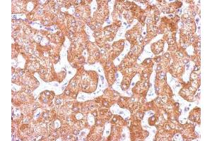 IHC-P Image Immunohistochemical analysis of paraffin-embedded human hepatoma, using GCP2, antibody at 1:500 dilution. (TUBGCP2 antibody  (N-Term))