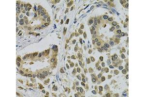 Immunohistochemistry of paraffin-embedded Human breast cancer using EBAG9 Polyclonal Antibody at dilution of 1:100 (40x lens). (RCAS1 antibody)