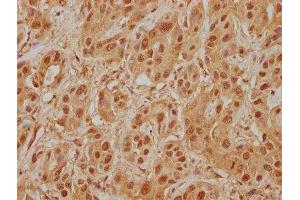 IHC image of ABIN7140070 diluted at 1:400 and staining in paraffin-embedded human liver cancer performed on a Leica BondTM system. (LRP1 antibody  (AA 3924-3942))