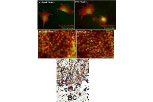 Formalin-fixed and paraffin-embedded human cancer tissue reacted with the primary antibody, which was peroxidase-conjugated to the secondary antibody, followed by DAB staining. (PACSIN2 antibody  (C-Term))