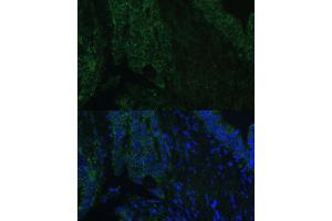 Immunofluorescence analysis of human colon carcinoma using CLC Polyclonal Antibody (5041) at dilution of 1:100 (40x lens). (CLCA1 antibody  (AA 22-150))