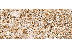 Immunohistochemistry of paraffin-embedded Human liver cancer tissue using MTAP Polyclonal Antibody at dilution of 1:70(x200) (MTAP antibody)