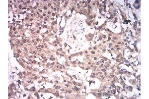 Immunohistochemical analysis of paraffin-embedded esophageal cancer tissues using ASH2L mouse mAb with DAB staining.