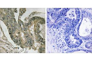 Peptide - +Immunohistochemistry analysis of paraffin-embedded human colon carcinoma tissue using ALDOC antibody. (ALDOC antibody  (Internal Region))