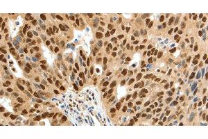 Immunohistochemistry of paraffin-embedded Human ovarian cancer tissue using SSB Polyclonal Antibody at dilution 1:50 (SSB antibody)