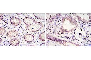 Immunohistochemical analysis of paraffin-embedded gastric cancer tissues (left) and lung cancer tissues (right) using CDH1 mouse mAb with DAB staining. (E-cadherin antibody)