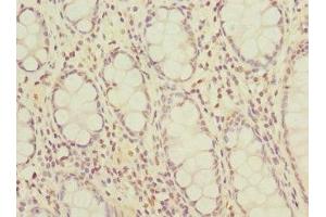 Immunohistochemistry of paraffin-embedded human colon cancer using ABIN7162234 at dilution of 1:100 (OGFR antibody  (AA 1-280))