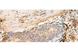 Immunohistochemistry of paraffin-embedded Human esophagus cancer tissue using HLA-DQB1 Polyclonal Antibody at dilution of 1:30(x200)
