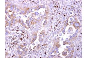 IHC-P Image LILRB5 antibody [N2C1], Internal detects LILRB5 protein at cytosol on human breast carcinoma by immunohistochemical analysis. (LILRB5 antibody  (Internal Region))
