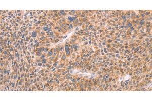 Immunohistochemistry of paraffin-embedded Human liver cancer using AASDHPPT Polyclonal Antibody at dilution of 1:30 (AASDHPPT antibody)