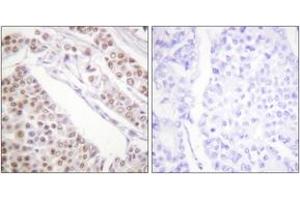 Immunohistochemistry analysis of paraffin-embedded human lung carcinoma tissue, using Histone H2B (Acetyl-Lys12) Antibody. (Histone H2B antibody  (acLys12))