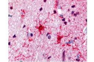 Rabbit anti-S100 was used at a 1:500 dilution to detect S100 by immunohistochemistry in human brain astrocyte tumor tissue. (S100A1 antibody)