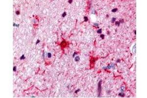 Rabbit anti-S100 was used at a 1:500 dilution to detect S100 by immunohistochemistry in human brain astrocyte tumor tissue. (S100 Protein (S100) antibody)