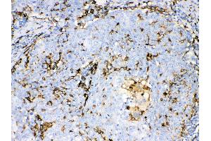 Iba1 was detected in paraffin-embedded sections of human lung cancer tissues using rabbit anti- Iba1 Antigen Affinity purified polyclonal antibody (Catalog # ) at 1 µg/mL.