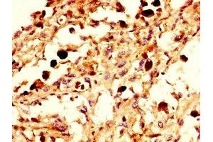 IHC image of ABIN7161390 diluted at 1:300 and staining in paraffin-embedded human melanoma performed on a Leica BondTM system. (NPAS4 antibody  (AA 445-585))