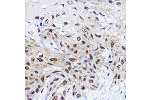 Immunohistochemistry of paraffin-embedded human esophageal cancer using SM Rabbit pAb (ABIN6132562, ABIN6148098, ABIN6148099 and ABIN6214424) at dilution of 1:100 (40x lens). (SMARCA1 antibody  (AA 1-200))