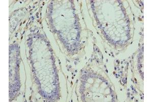 Immunohistochemistry of paraffin-embedded human colon cancer using ABIN7176373 at dilution of 1:100 (ZNF555 antibody  (AA 1-200))