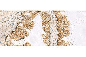 Immunohistochemistry of paraffin-embedded Human prost at e cancer tissue using SH3YL1 Polyclonal Antibody at dilution of 1:55(x200) (SH3YL1 antibody)