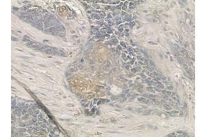 ABIN6257231 and ABIN6273685 at 1/100 staining human breast carcinoma by IHC-P. (Keratin 77 antibody  (Internal Region))