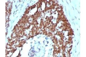 IHC testing of FFPE human ovarian carcinoma with Nucleolin antibody (clone NPC23-2).