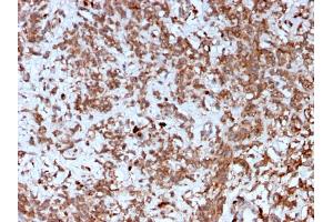 Formalin-fixed, paraffin-embedded human Liver stained with Cathepsin K Mouse Monoclonal Antibody (CTSK/2792). (Cathepsin K antibody  (AA 163-274))