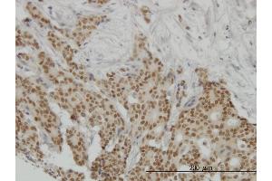 Immunoperoxidase of monoclonal antibody to PGR on formalin-fixed paraffin-embedded human breast cancer. (Progesterone Receptor antibody  (AA 1-110))