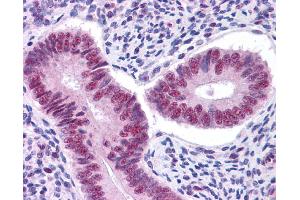 Immunohistochemistry (IHC) image for anti-Signal Transducer and Activator of Transcription 3 (Acute-Phase Response Factor) (STAT3) (Middle Region) antibody (ABIN504617) (STAT3 antibody  (Middle Region))