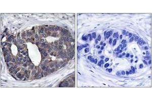 Immunohistochemistry analysis of paraffin-embedded human breast carcinoma tissue, using p62 Dok (Ab-362) Antibody.
