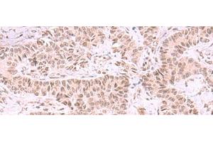 Immunohistochemistry of paraffin-embedded Human ovarian cancer tissue using MCMBP Polyclonal Antibody at dilution of 1:35(x200) (MCMBP antibody)